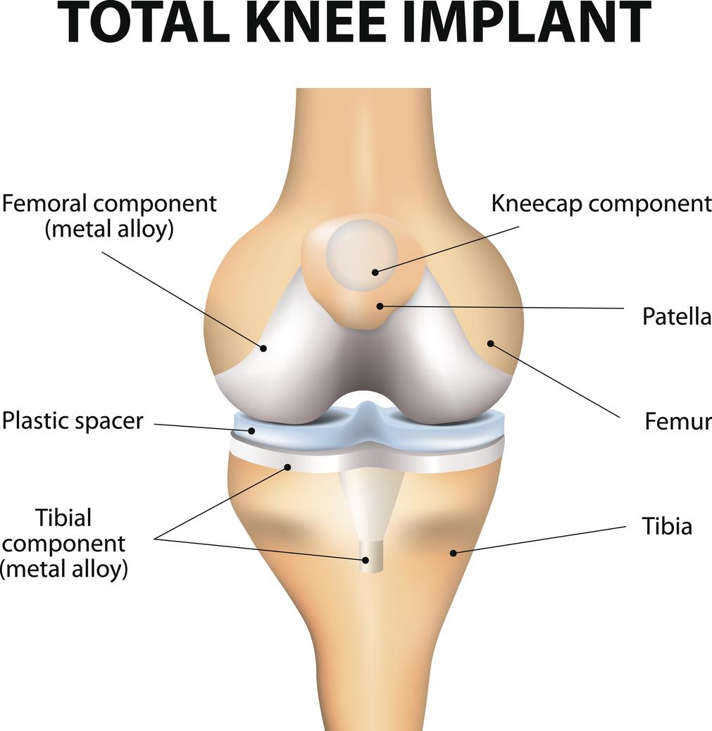 DePuy Synthes Attune Knee Implant Failure