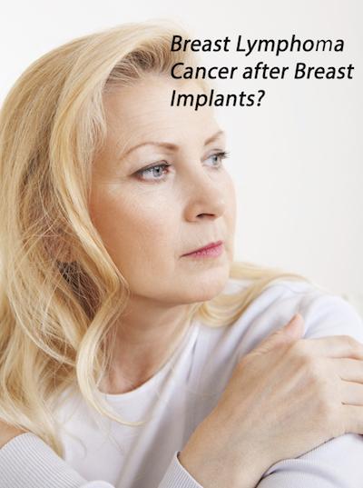 Breast Lymphoma Cancer after Breast Implants?